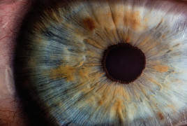 Eye ocular melanoma