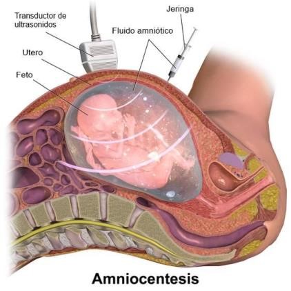 Amniocentesis