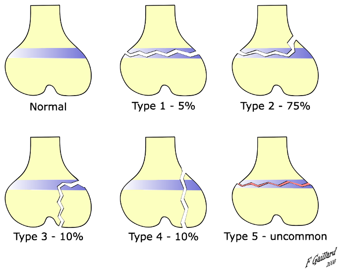 Clasificación Salter Harris de las epifisiolisis 