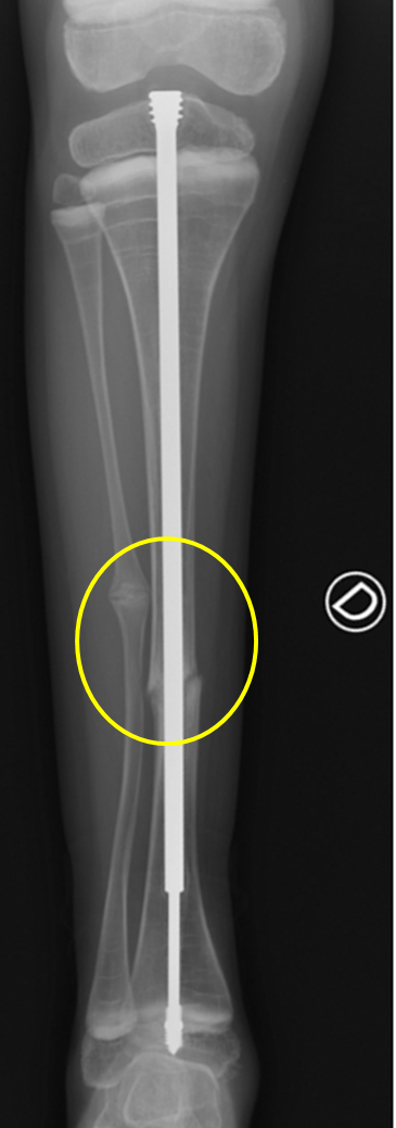 Radiografía fractura