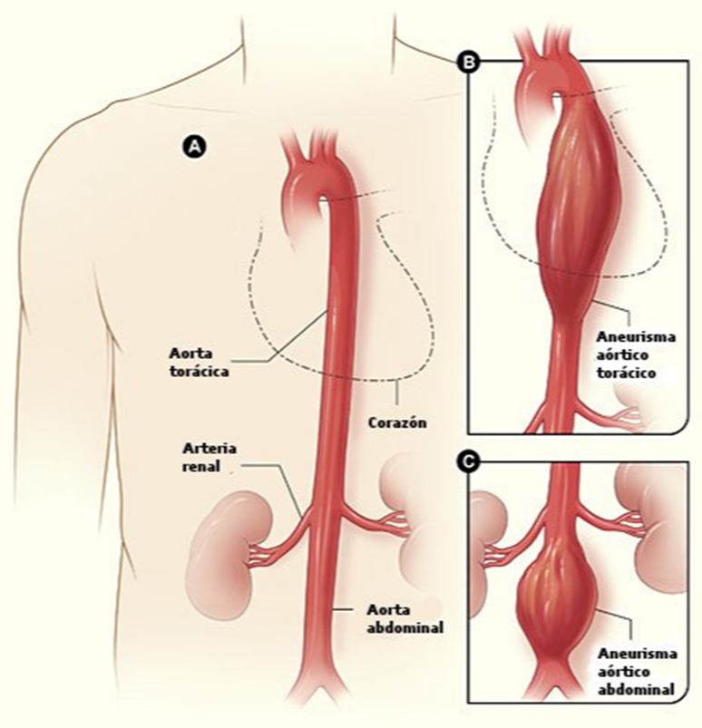 Aneurisma de aorta