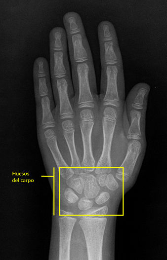 Radiografía huesos cortos del carpo 