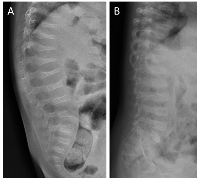 Capacidad de remodelado vertebral en los niños