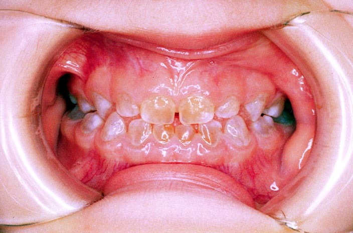 Dientes afectados por dentinogénesis imperfecta