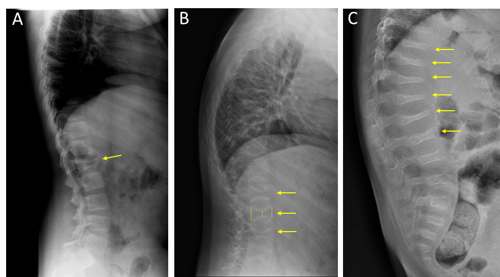 Radiografías laterales de columna en pacientes con OI
