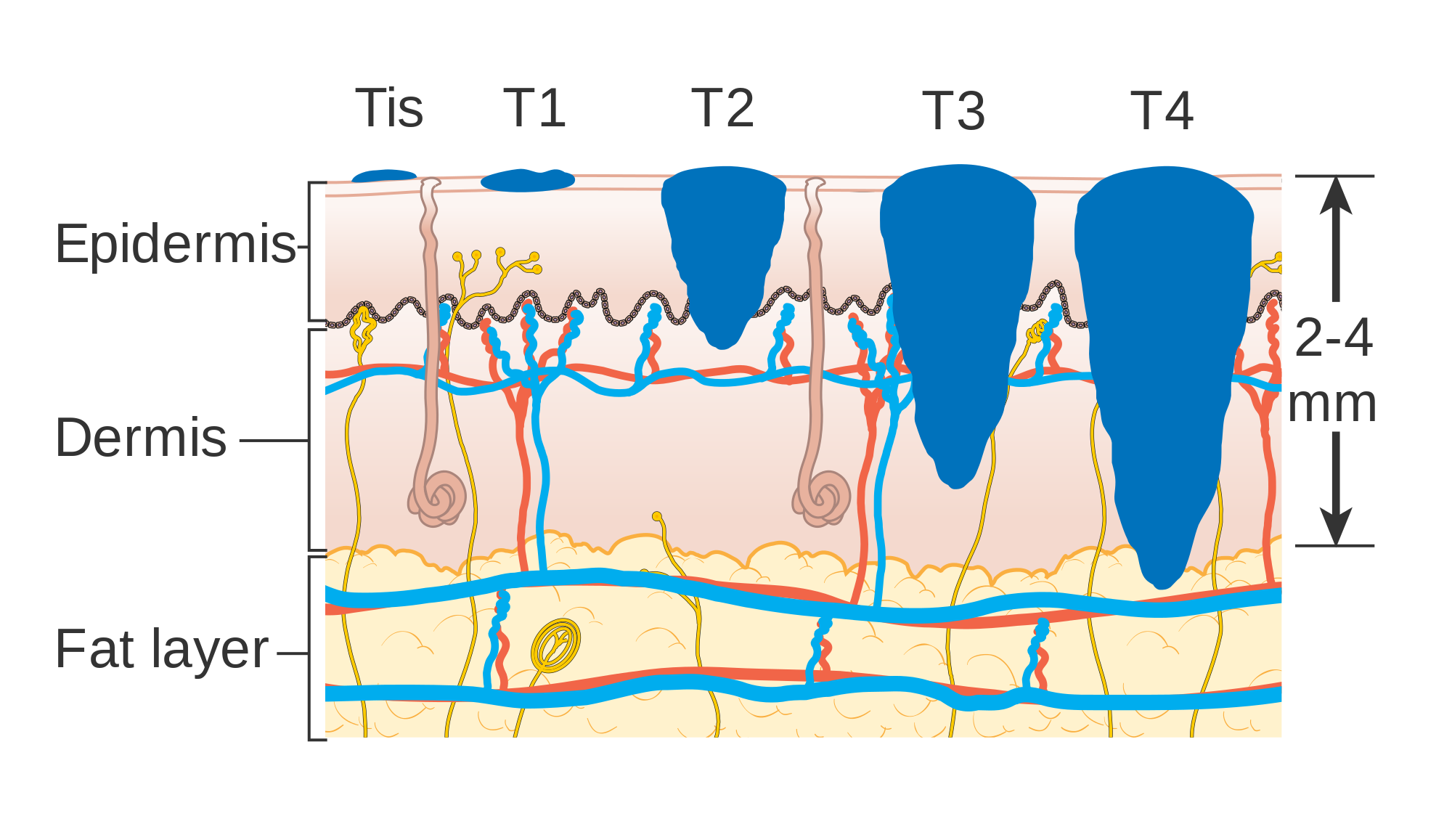 Diagram showing the T stages of melanoma