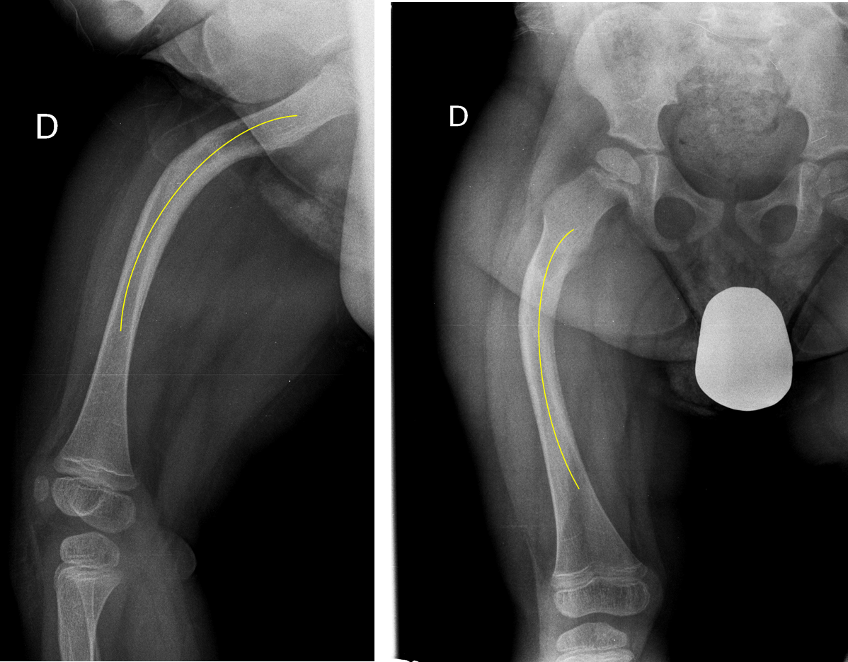 Radiografía de un fémur derecho incurvado en dirección anterior y lateral