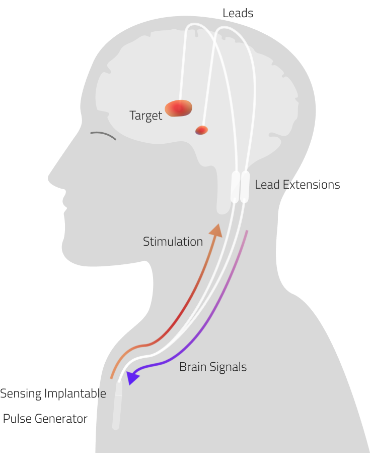 Deep Brain Stimulation