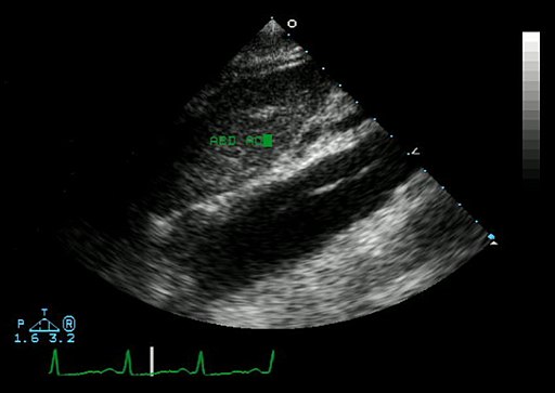 Ecocardiograma