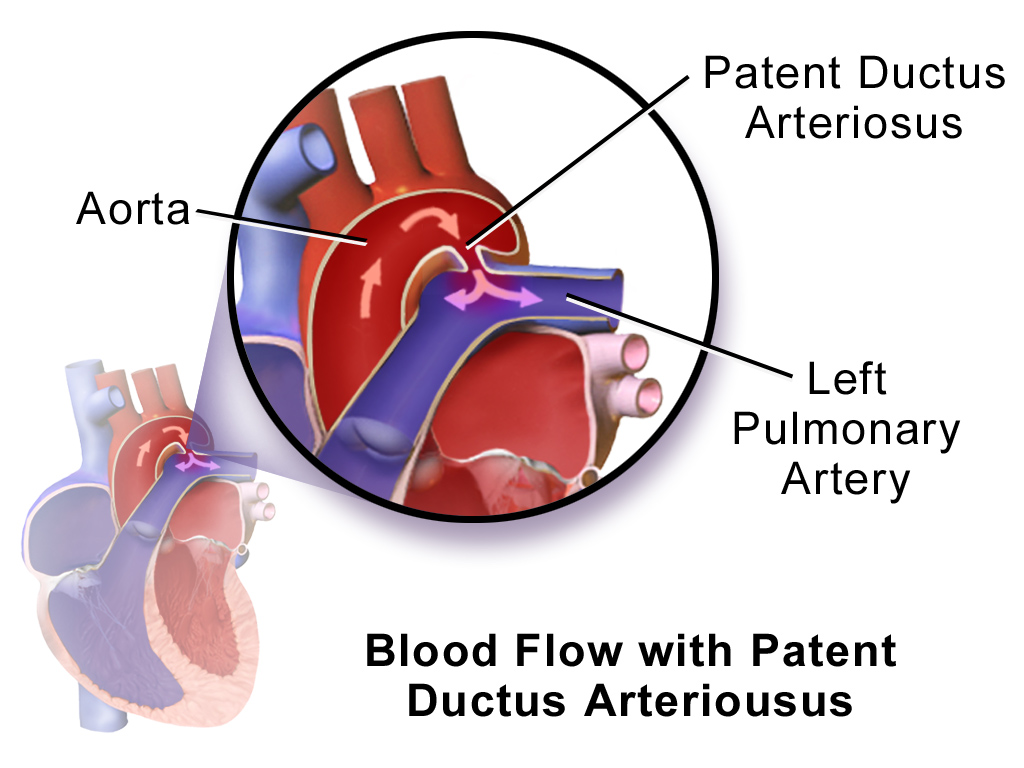 Ductus arterioso