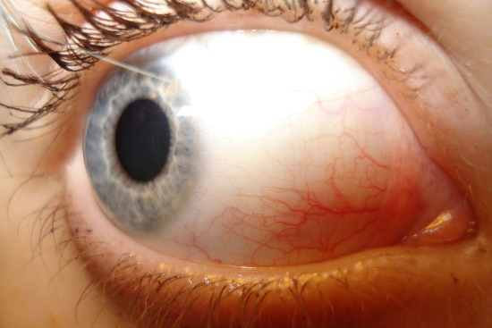 Conjuntiva ojo