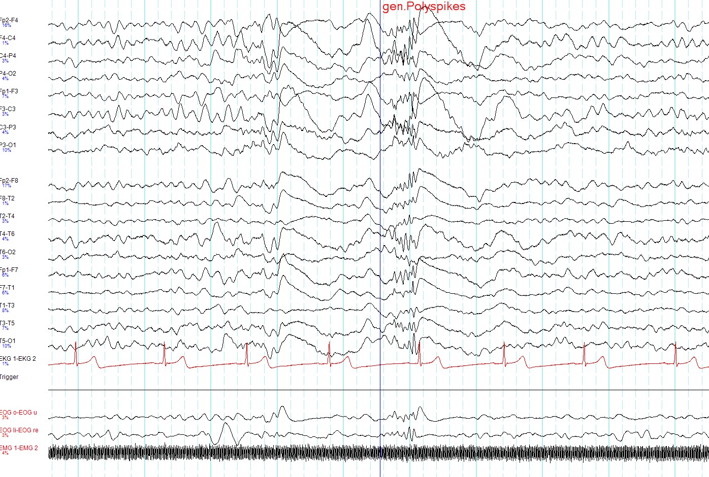 Electroencefalograma