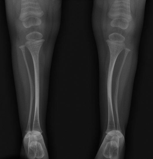 Tibia y peroné de una niña afecta de OI