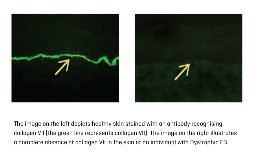 Immunofluorescence mapping epidermolysis