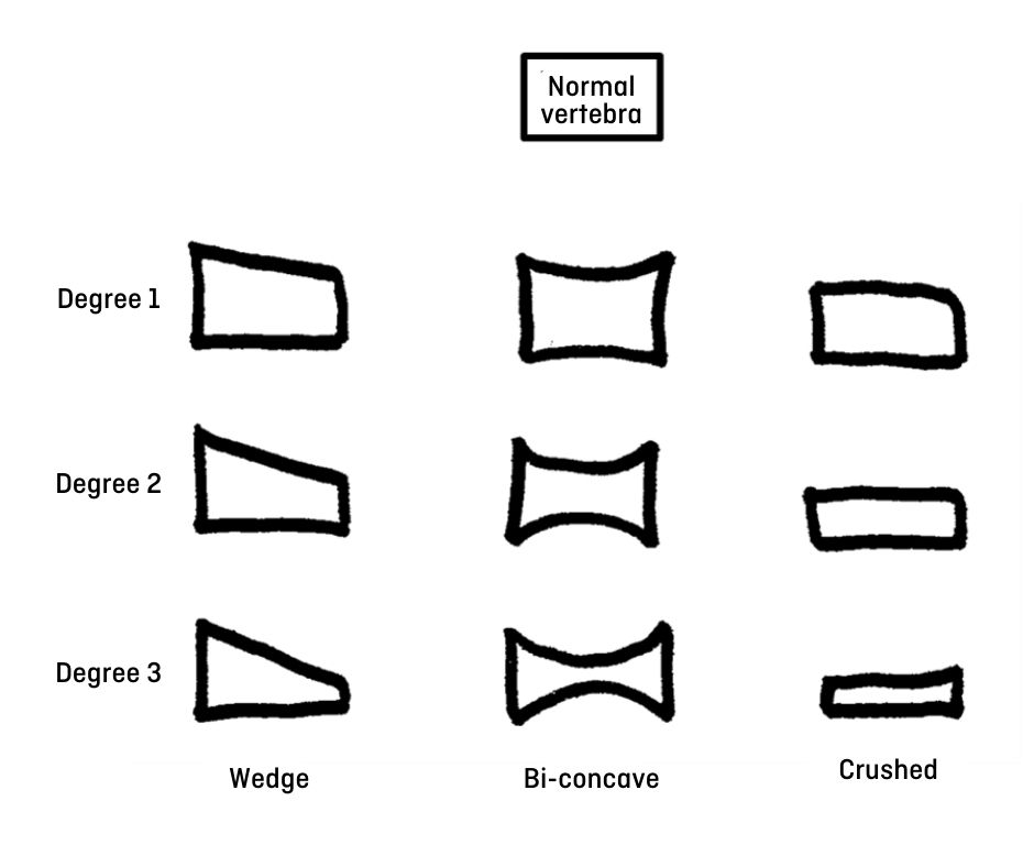 Vertebrae fractures