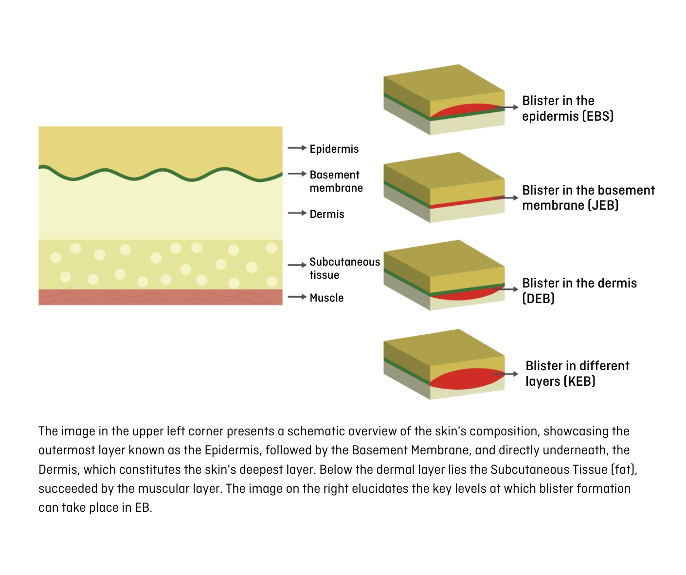 Types of epidermolysis bullosa skin layers blister