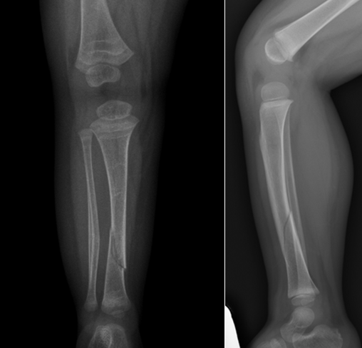 Fractura espirodea 