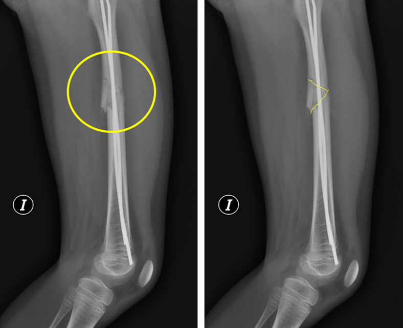 Fracture butterfly