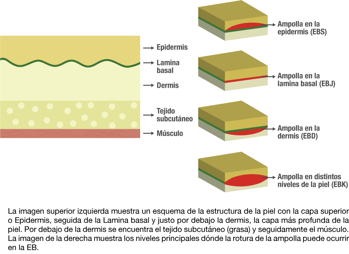 Capas de la piel donde se genera la ampolla