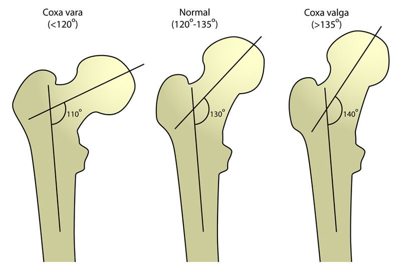 coxa valga coxa vara hip