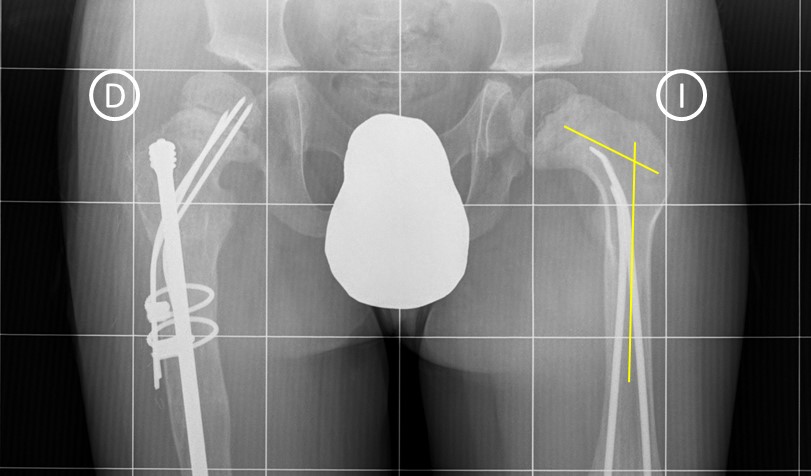 X-ray hip osteogenesis imperfecta