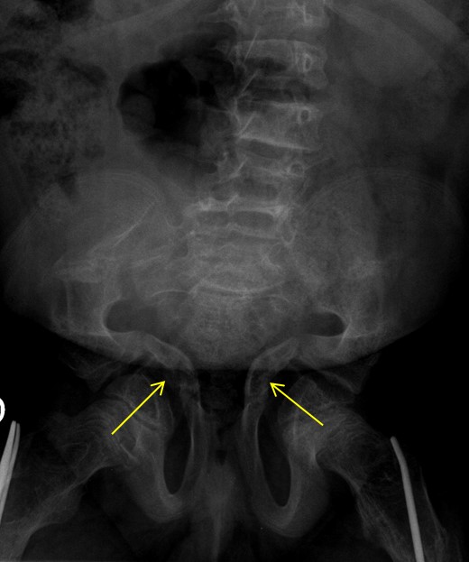 acetabular protrusion hip osteogenesis imperfecta