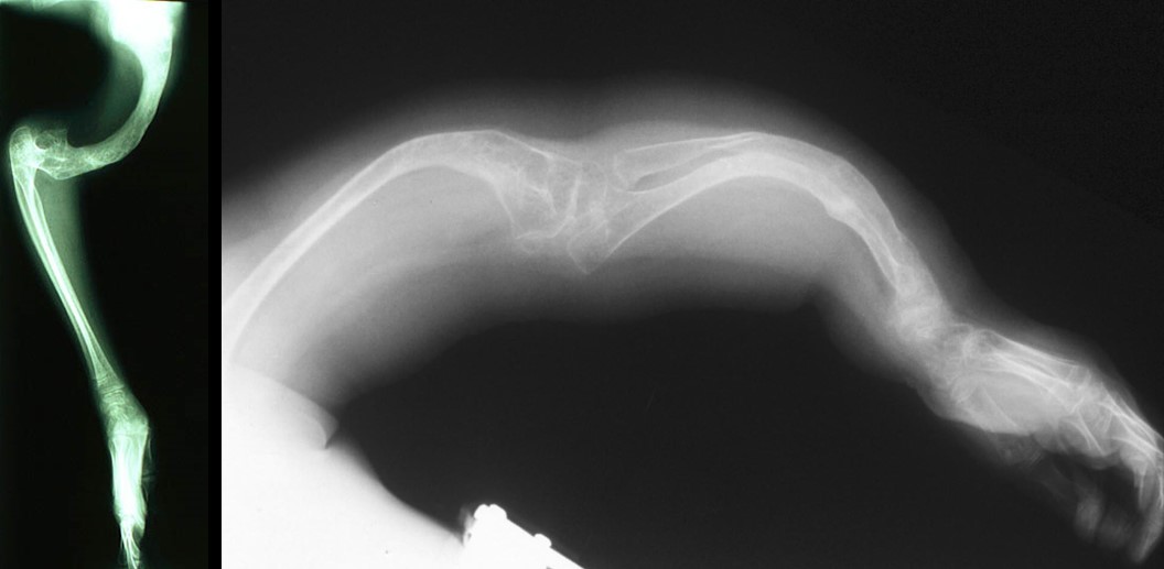 X-ray bones curvature upper extremities