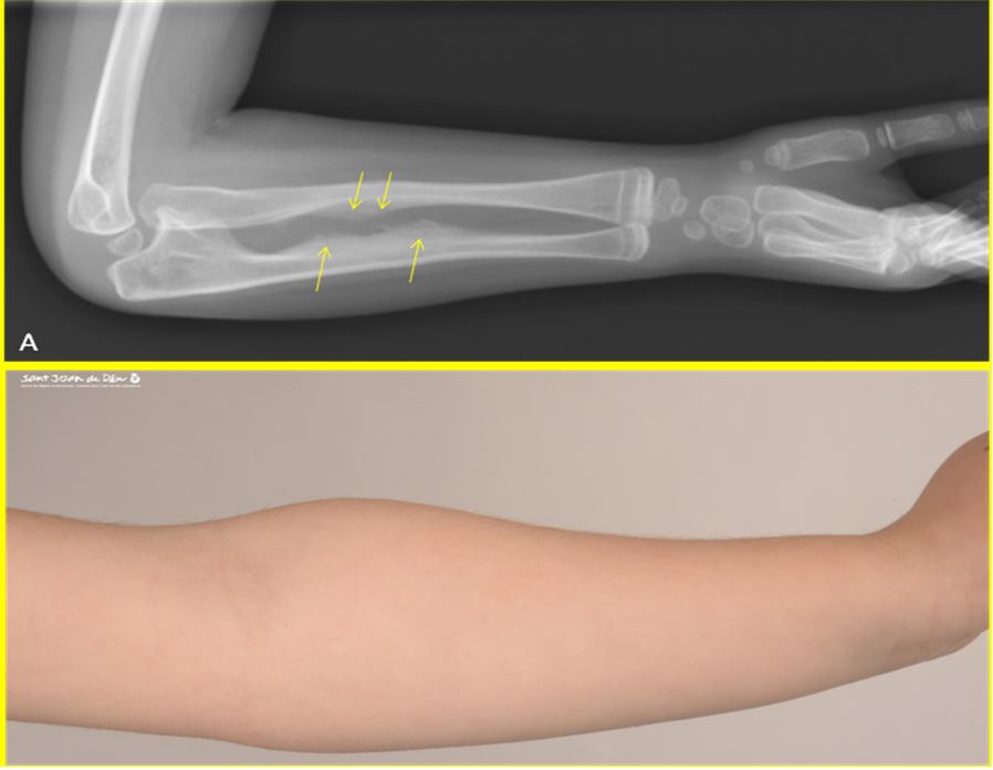 Calcification deformity forearm dislocation radius