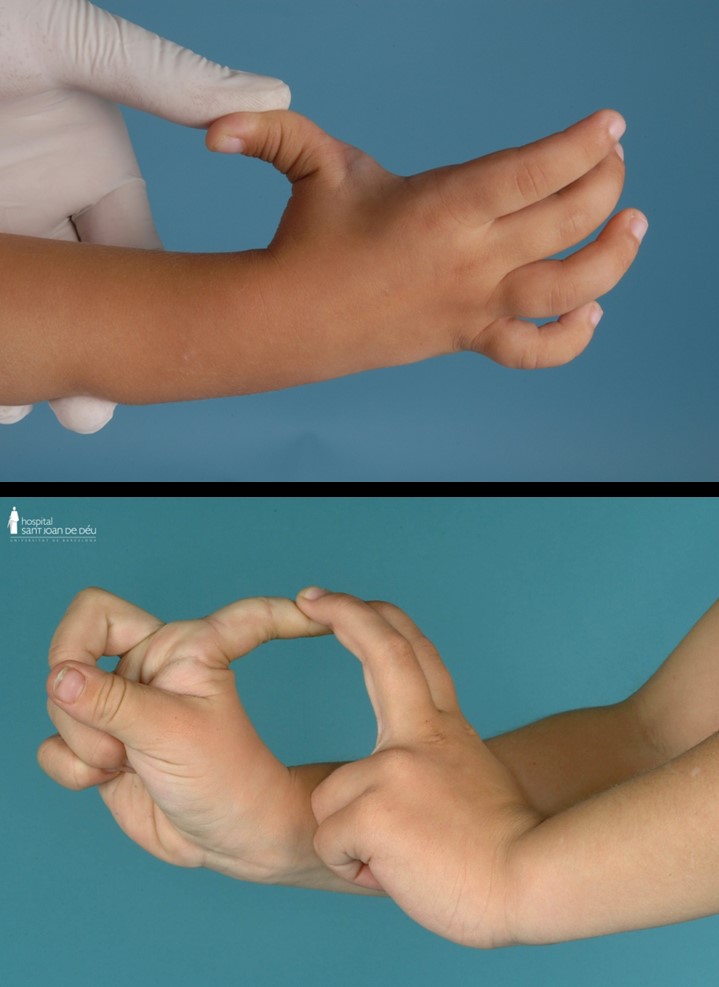 hand fingers children osteogenesis joint hypermobility