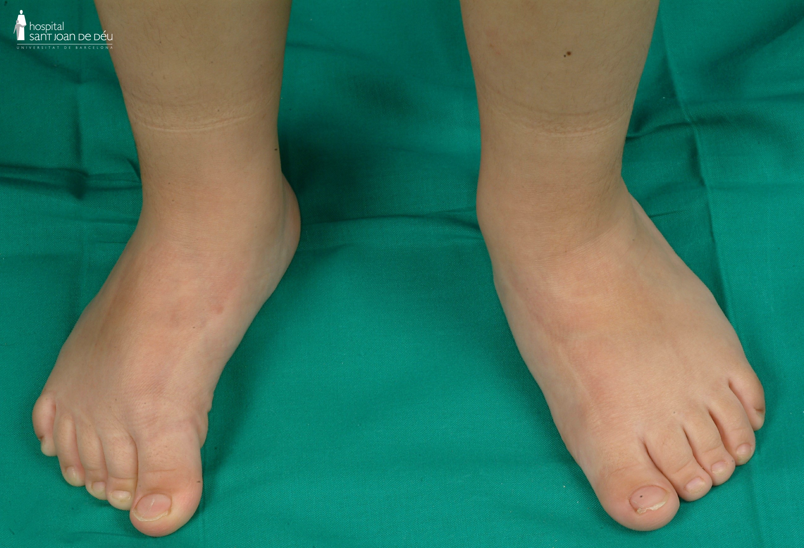 flat foot osteogenesis imperfecta