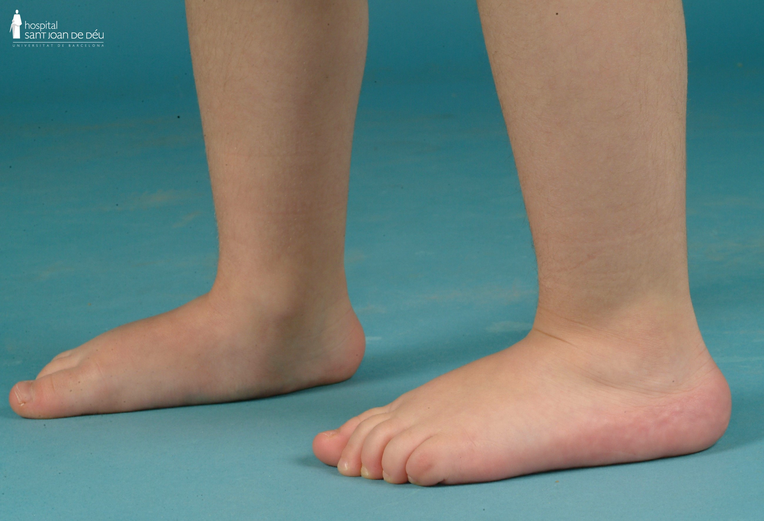 Flat foot osteogenesis imperfecta child