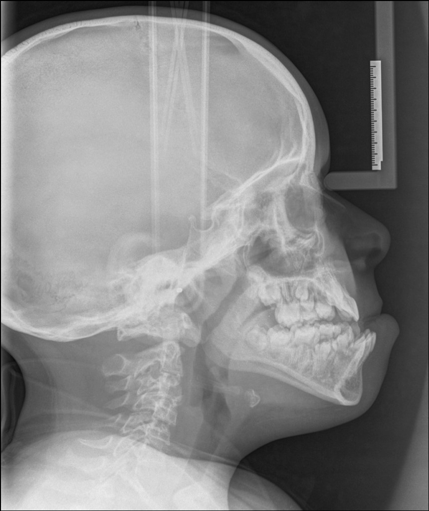 X-ray of a patient with class III malocclusion