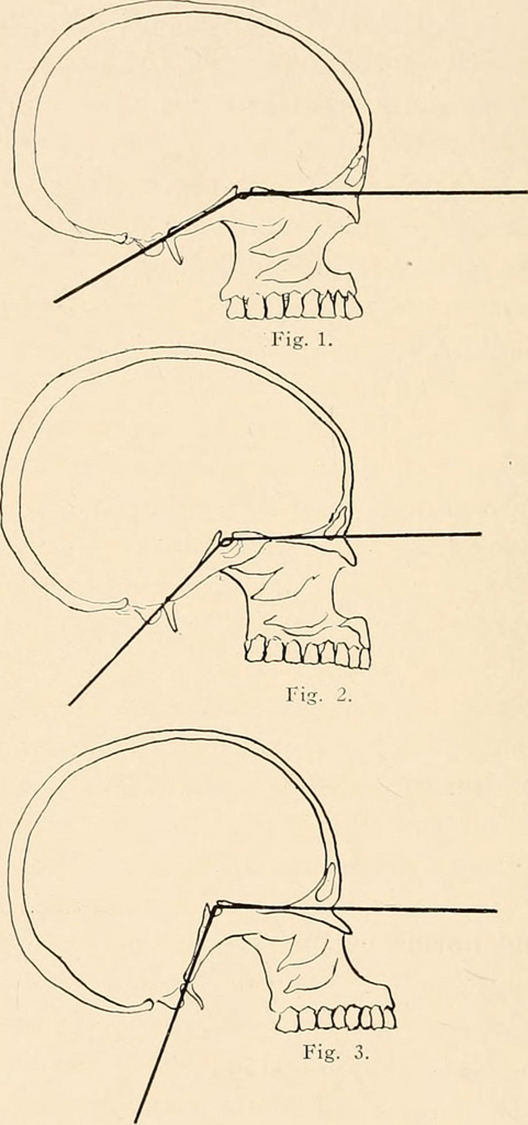Lateral images of the cranium