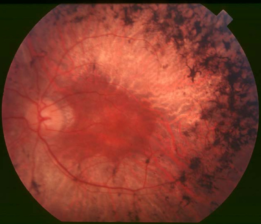 fondo ojo retinitis pigmentaria