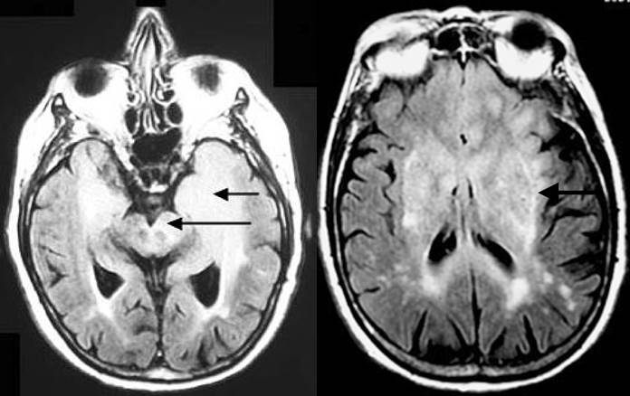 MRI images from gliomatosis cerebri. Wikipedia