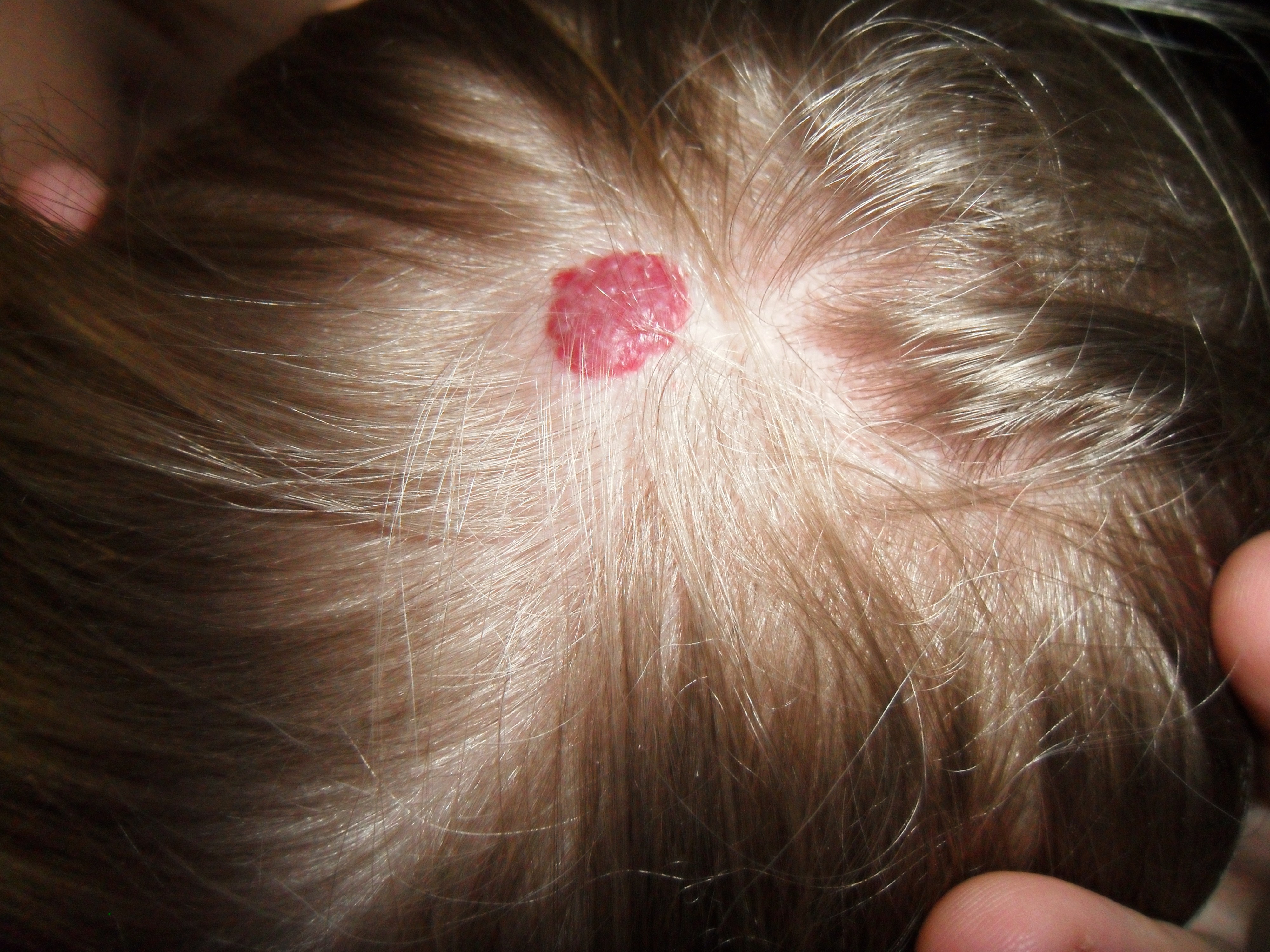 Hemangioma. Wikipedia