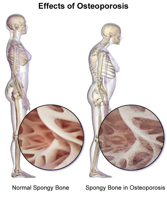 Efectos de la osteoporosis