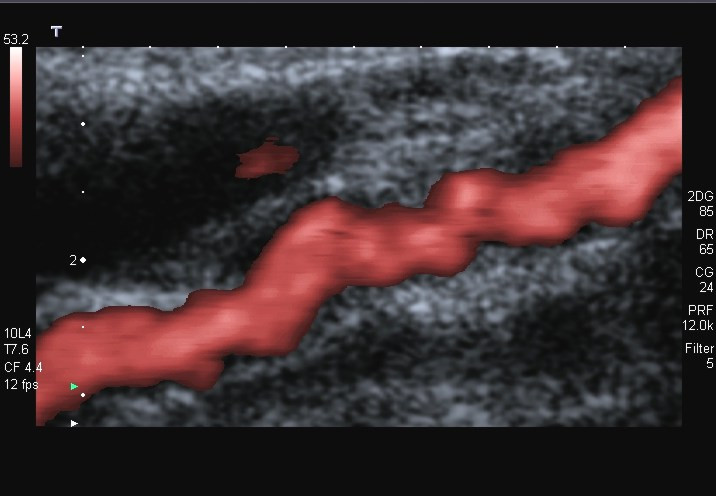 Ecografía Doppler