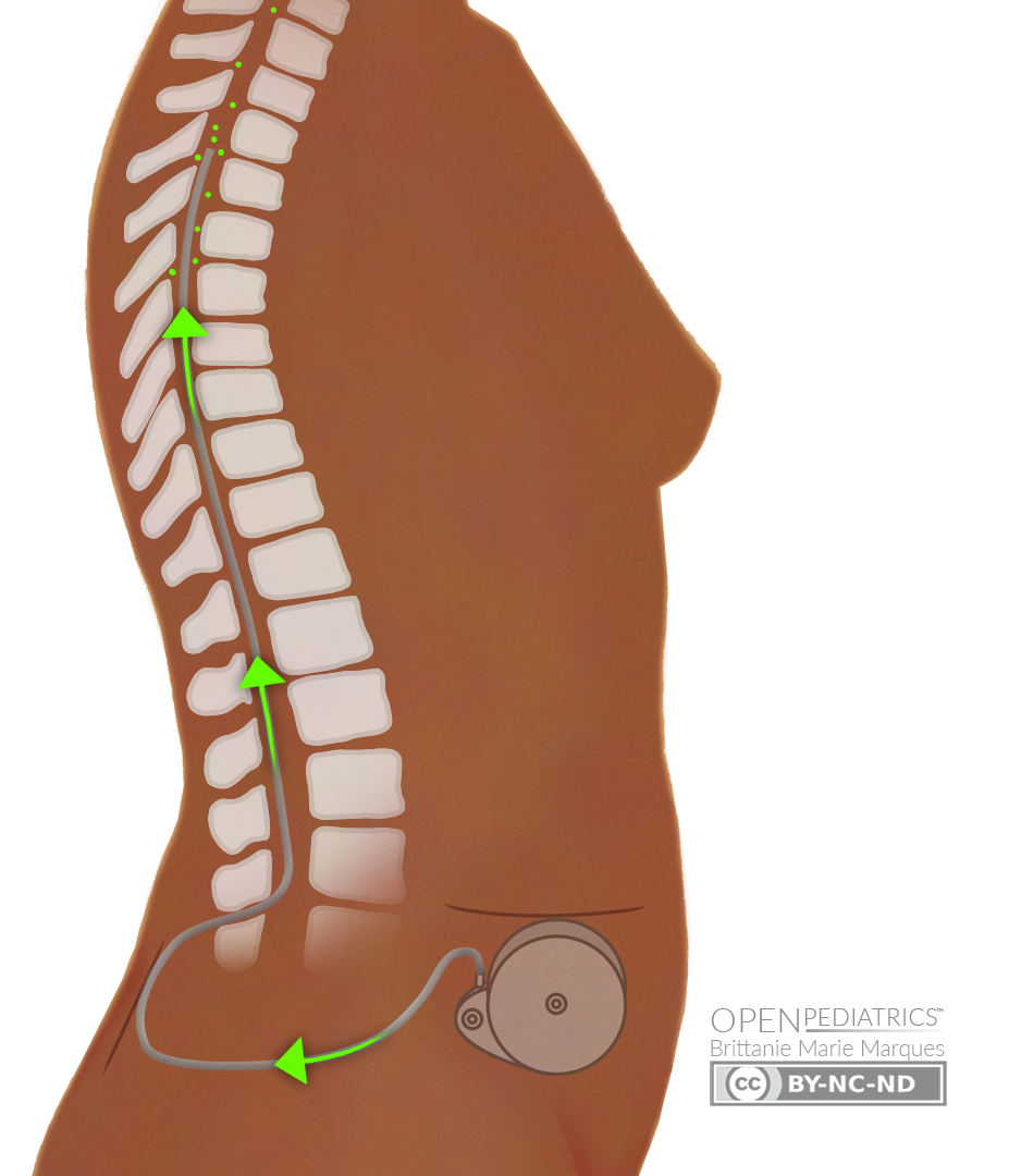 administración intratecal