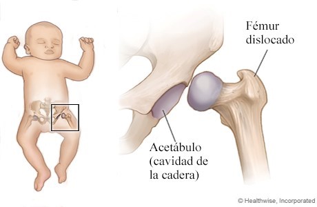 Displasia de cadera