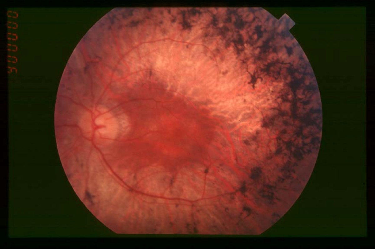 Retinosis pigmentaria