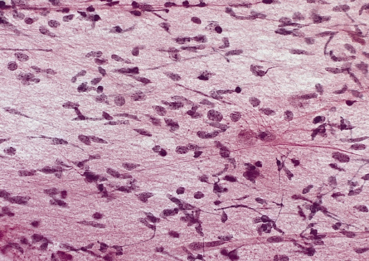 Gliomatosis cerebri sample stain under microscope. Wikipedia