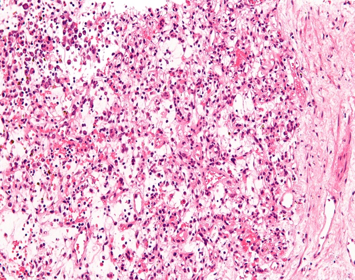 Histological examination of IMTs