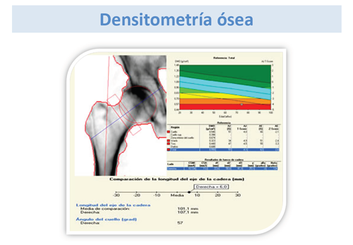 Osteopenia