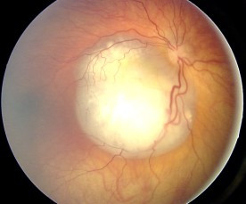 Retinoblastoma fundoscopic examination