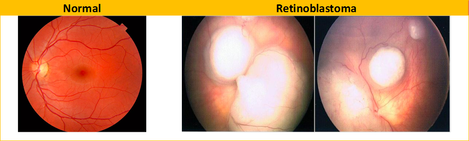 Normal fundoscopy and abnormal fundoscopy in eyes affected with RB