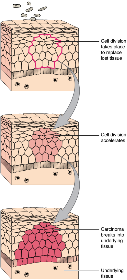 Skin invasive process cabcer