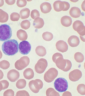 Abnormal lymphocytes in the blood 
