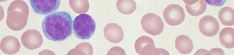 Abnormal lymphocytes in the blood 