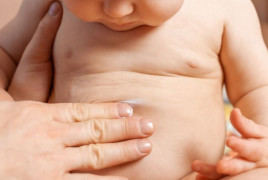 bebe vientre malformacion anorrectal hirschsprung